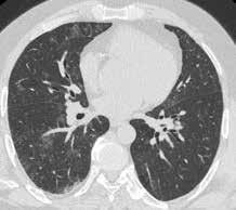 Pulmoner alveoler proteinozisli hastada iki taraflı total akciğer lavajı Resim 6. Total akciğer lavajı sonrası önceki akciğer YRBT ile karşılaştırıldığında lezyonlarda belirgin regresyon saptandı.