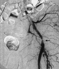 Resim 1. Sol femoropopliteal bypass greftin (PTFE) proksimal anastomozu düzeyinde yaklafl k %95 lik stenoz (ok) görülüyor (A).