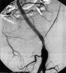 Sa femoropopliteal bypass greftte (PTFE), proksimal anastomotik-perianastomotik düzeyde >%95 lik stenoz (ok) görülüyor (A).