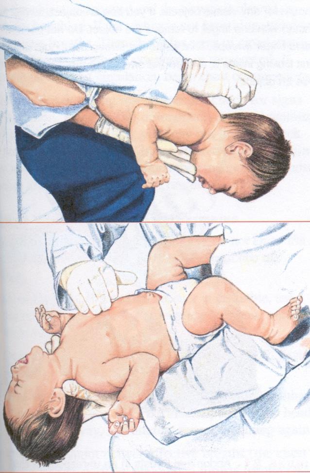 Hava Yolu Tıkanıklığı Sonra bebeği kolunuzda sırt üstü yatırın. Kalp masajı yapılan yere 5 göğüs hamlesi yapın.