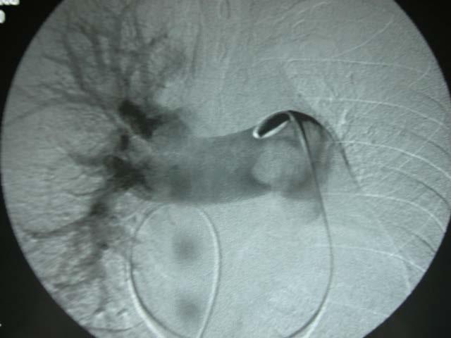 Kime pulmoner anjiyografi?