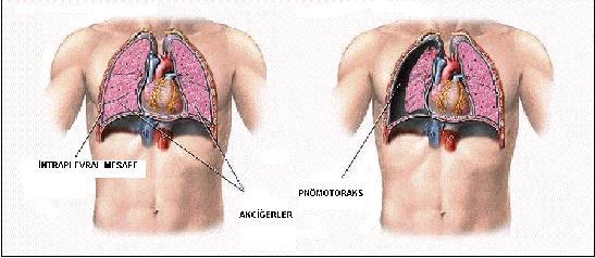 Tansiyon pnömotoraksa neden