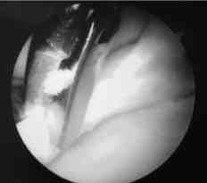 102 Acta Orthop Traumatol Turc fiekil 7. Dejenere ligamentum teres lezyonu. nucu bildiren Glick ve ark.