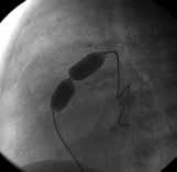 Oksijen satürasyonunda yeterli artma görülmeyince, PGE 1 kesilerek pulmoner taraf daralm fl olan duktus arteriozusa transvenöz yoldan 6F k lavuz kateterle 3.