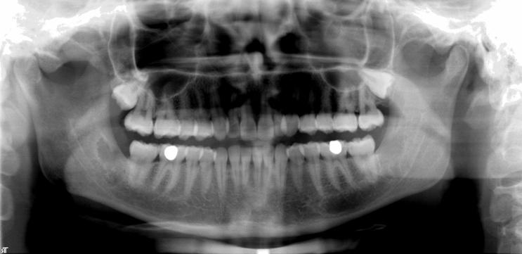 4. BULGULAR 4.1 Klinik Bulgular 6 ay klinik takibi yapılan hastalarımızın hiç birinde uzun dönemde ciddi bir komplikasyon yaşanmamıştır. Başlangıç postoperatif 1. ve 2.