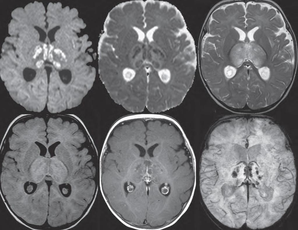 MR bulguları: Bilateral talamus tutulumu olan simetrik ve multifokal beyin lezyonları bulunur.