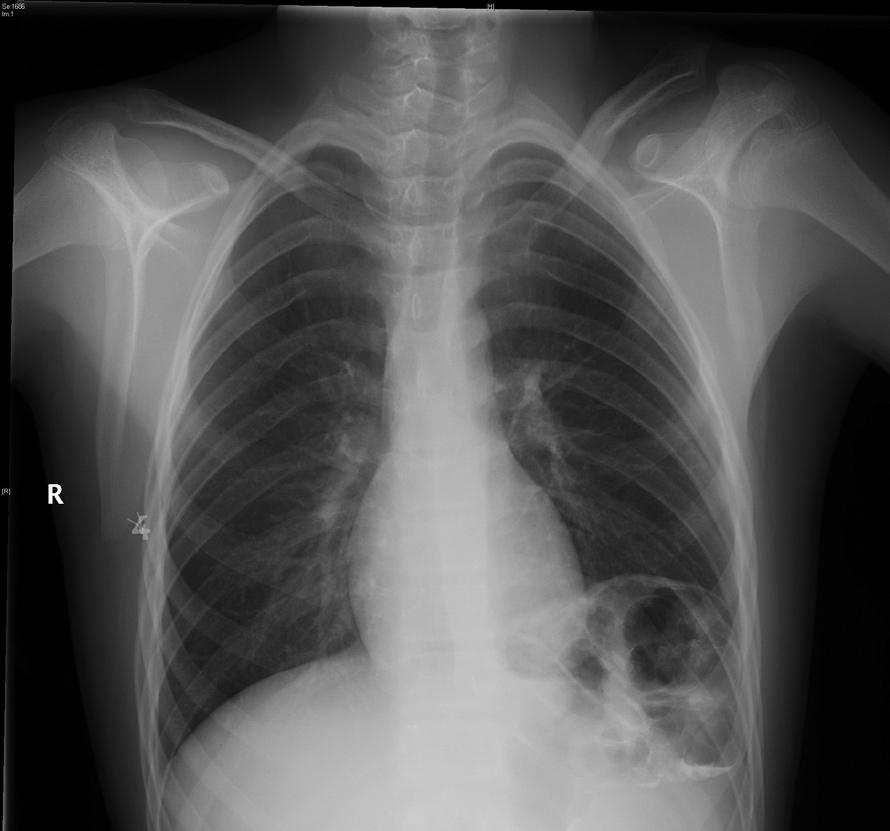 Çocuk Cerrahisi Dergisi 28(1):26-30, 2014 trafik kazası geçirdiği, dalak laserasyonu, sol temporal ve oksipital kemik fraktürü ve sağ tibia fraktürü nedeniyle bir travma yoğun bakım merkezinde tedavi