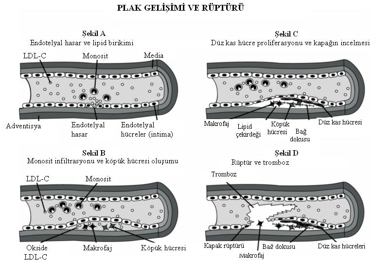 Şekil 1. Plağın gelişimi ve rüptürü Kumar V, Cotran RS, Robbins SL. Basic Pathology.