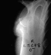 8 Eklem Hastal klar ve Cerrahisi - Joint Dis Rel Surg bir hastada tüberkulumlarda deplasman gözlenmedi. Komplikasyon olarak bir hastada heterotopik ossifikasyon geliflti.