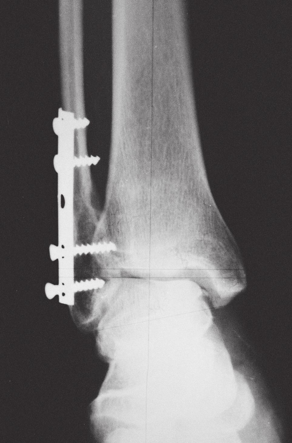 (a) (b) Figure 3. Post-operative AP (a) and Figure 3. Post-operative lateral (b) radiographs of the patient after 45 months. Internal fixation with plate and screw was used for lateral malleolus.