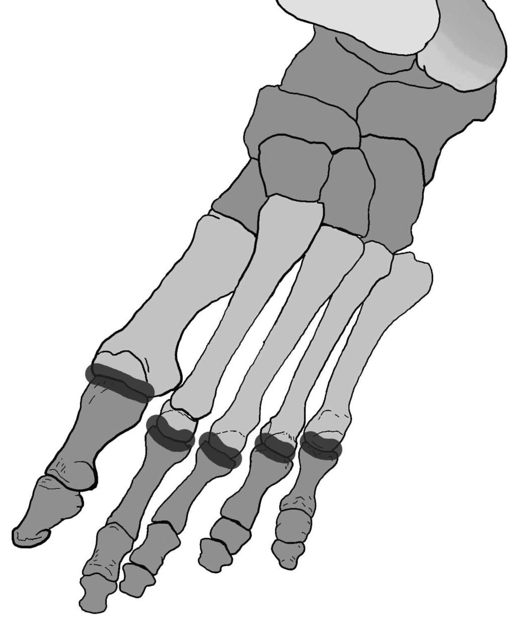 Articulationes metatarsophalangeales; articulatio ellipsoidea tipi eklemdir. Ayak tarak kemikleri ile falankslar arasındadır.