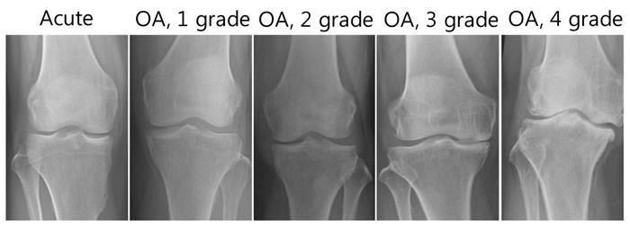 Şüpheli eklem aralığı daralması ve muhtemel osteofit Kesin osteofit ve muhtemel eklem aralığı daralması Orta derecede mültipl