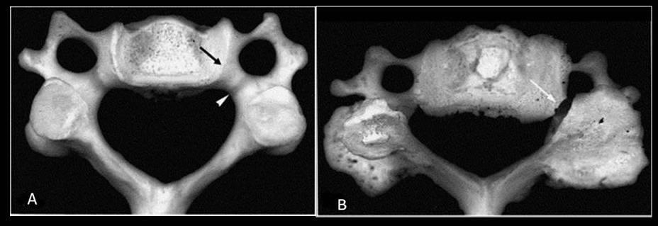 intervertebrale yi daraltarak nervus spinalis in sıkışmasına yol açar. Raf şeklindeki genişleme, processus uncinatus un aksi yönüne ilerlediğinde foramen transversarium a projekte olabilir.