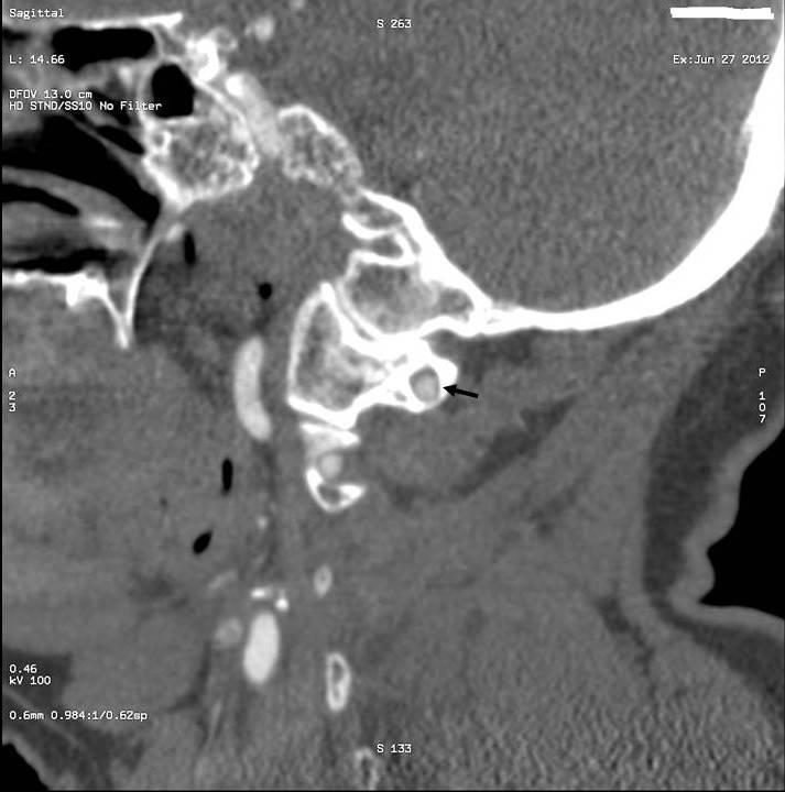 Resim 10: Sagittal reformat kesitte, C2 düzeyindeki AV nin FT içerisinde ölçümü.