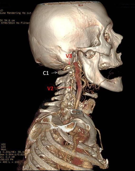 Resim 15: Aynı olgunun AV sinin V2 ve V3 parçası ile columna