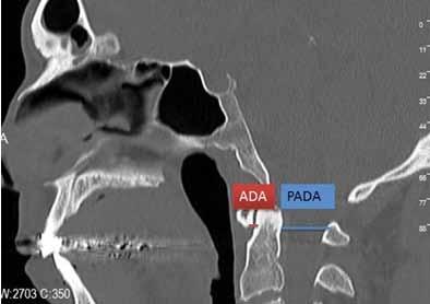 McRae Hattı: Klivus alt ucundan (bazion) foramen magnum posterosüperioruna (opistion) çizilen hattır ve 19 mm den büyük olmalıdır.