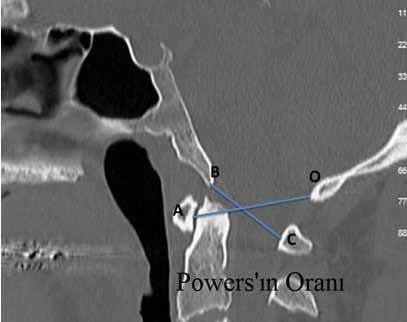 X- Çizgisi Metodu (Oksipital-aksiyal hatlar metodu): Aksis gövdesinin posteroinferior köşesinden opistiona çizilen hat C1 in en üst spinolaminar hattı ile teğet olmalıdır.