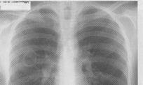 Tbc Akciğer absesi