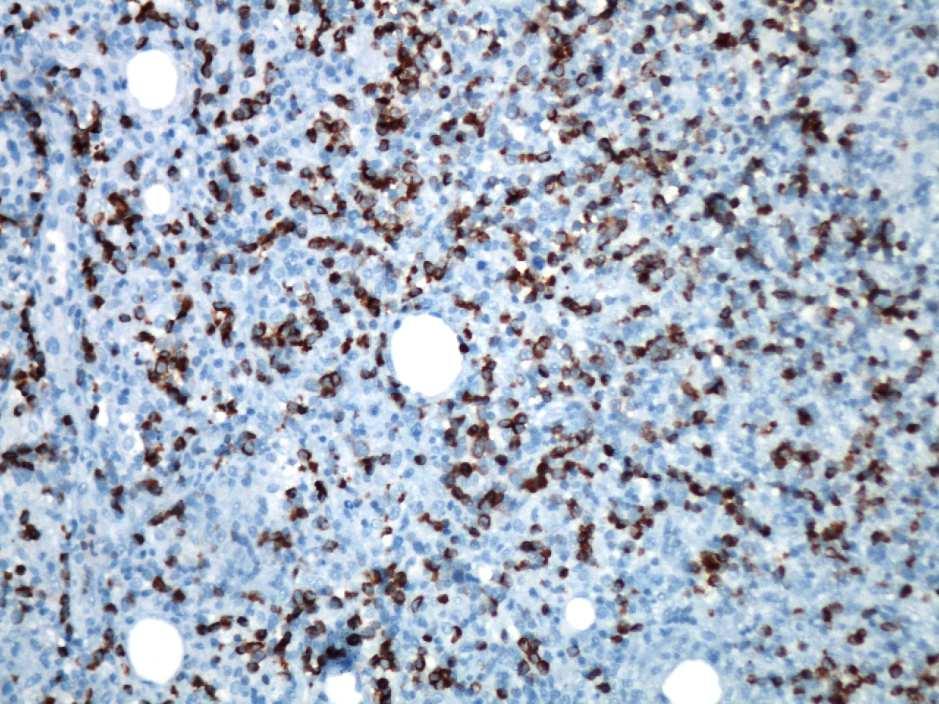 70 4.4. Apoptotik parametreler ve GADD45γ Metilasyon Profili ile İlişkileri 4.4.1. Bcl-2 ve Bcl-x L Protein Ekspresyonu Tablo 4.