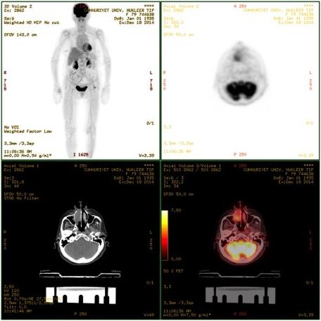 Özgeçmişinde hipertansiyon, geçirilmiş koroner anjiografi ve stent uygulaması mevcut olduğundan ve anterior tampon ile kanaması kontrol altına alındığından tamponu çıkartılmadan takip için hasta KBB