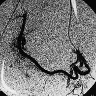 genifl ve k vr ml bir görünüm ald ve uterusta leyomyoma ait yo un patolojik vaskülarizasyon alan dikkat çekiyor (A).