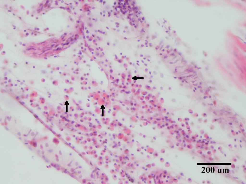 Şekil.3.33. Peritonitis.