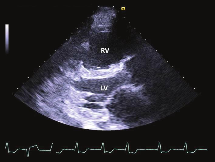 110 Türk Kardiyol Dern rş C D Şekil 1. Pulmoner hipertansiyon varlığında transtorasik ekokardiyografi ile parasternal uzun aks, kısa aks ve apikal 4 boşluk pencerelerinin incelenmesi.