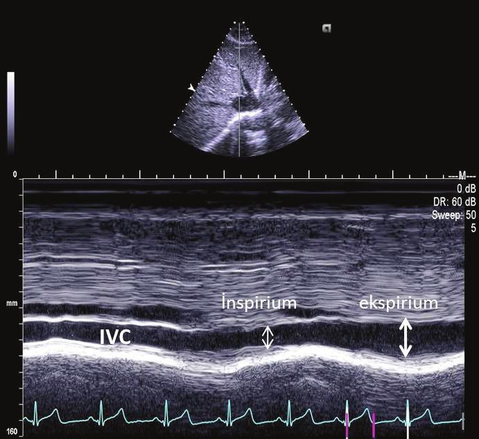 yrıca PH ye yol açabilen atriyal septal defekt varlığı da araştırılabilir.