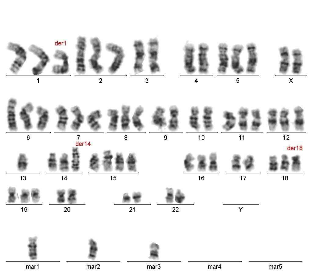 53 Şekil 3.3. Karyotip: 62,XX,+2,+5,+6,+7,+8,+11,+12,+15,+16,+19,+der(1), +der(14),+ der(15),+der(18),+mar1,+mar2,+mar3 [3] Aşağıda şekil 3.