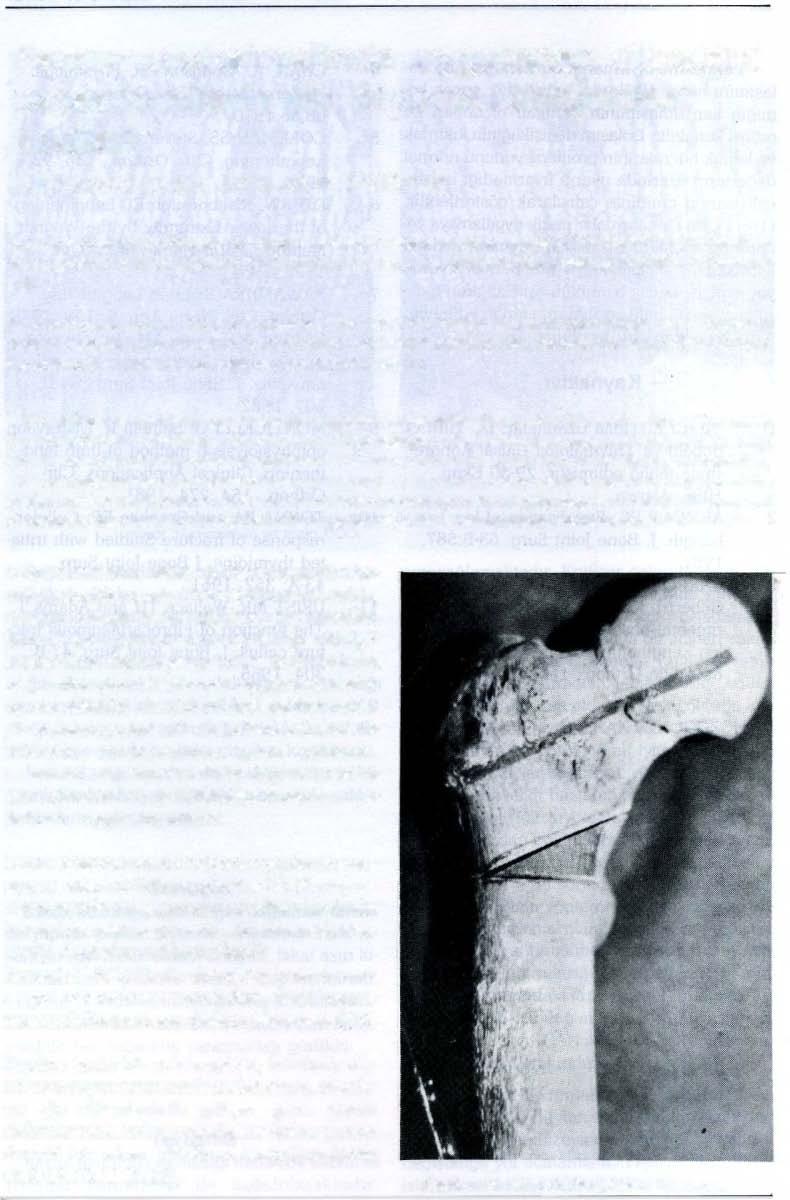 Acta Orthop. Traum. Turc. 20, 268-274, 1986 Femur proksimalinde uygulanan düzeltici osteotomilerin diz biyomekaniğindeki etkileri * E. KAYIRAN (1) S_K. EROL (2) S.