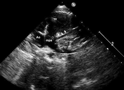 Ceylan ve ark. Pulmoner arterden çıkan anormal sol koroner arter Şekil 1.