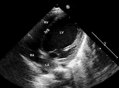 EKG de patolojik Q dalgası ve EKO da sol ventrikül sistolik fonksiyonlarının ölçümü daha önce yapılmış çalışmalardaki kriterlere göre değerlendirildi.
