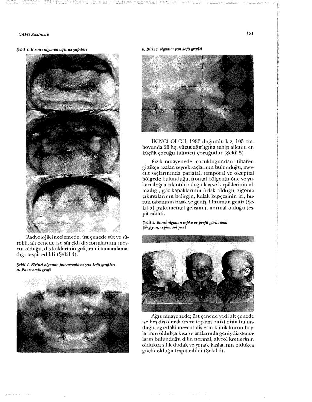 GAPO Sendromu 151 Şekil S. Birinci olgunun ağız içi yapıları b. Birinci olgunun yan kafa grafisi İKİNCİ OLGU; 1983 doğumlu kız, 105 cm. boyunda 25 kg.