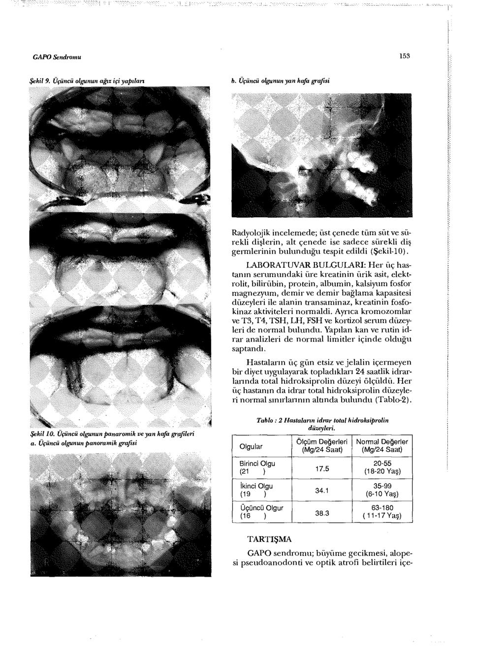GAPO Sendromu 153 Şekil 9. Üçüncü olgunun ağız içi yapıları b.