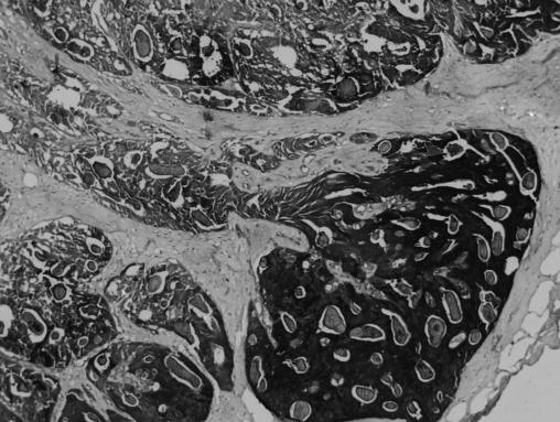 GCDFP-15, invaziv lobuler karsinomların yaklaşık %30 unda hücrelerde apokrin özellik gözlenmeksizin eksprese edilmektedir (16,17).