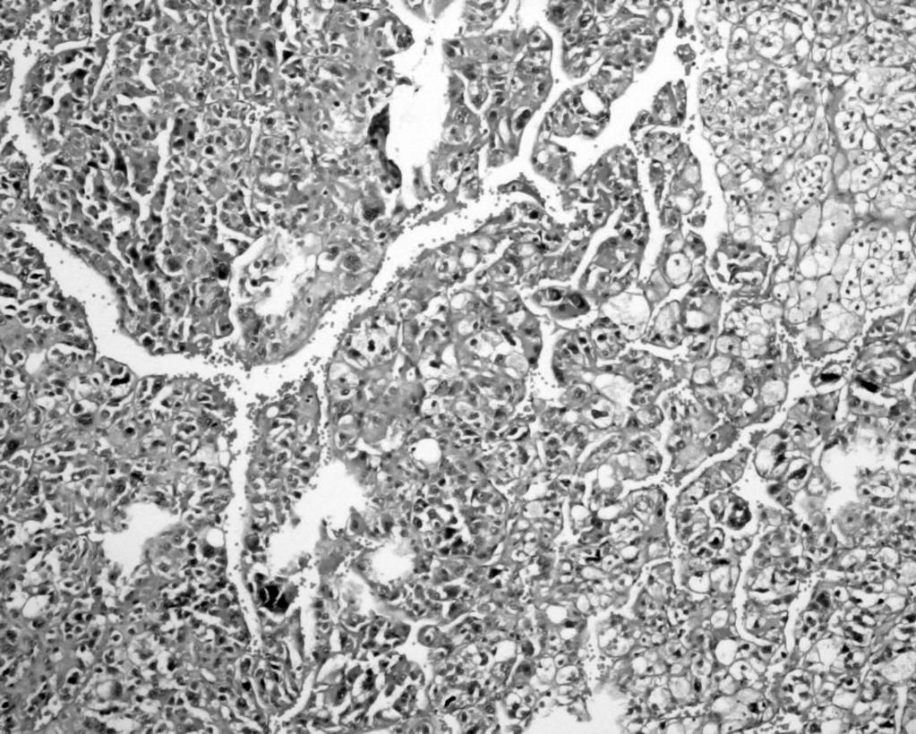 Bazı tümörlerde zona retikülaris hücrelerine benzer şekilde daha eozinofilik sitoplazmalı hücreler eşlik eder. Bazı hücrelerde lipokrom pigmenti bulunur.