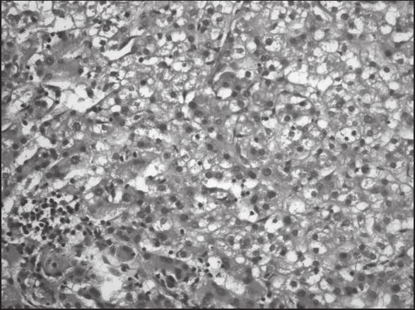 D. Orhan, Çocuk onkolojik cerrahi hastalıklarda patoloji hiyalinize septumlarla ayrılır, stromada mukoid görünüm saptanabilir. Resim 10. Embriyonal tip hepatoblastom (HE, X200).