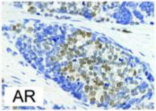 negative tumour cells AR positive tumour