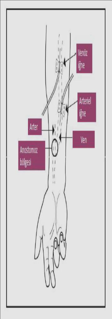 başlangıçta ince iğneler (17 G) Arter ve ven girişleri arasında 2,5-5 cm mesafe olmalı AVF