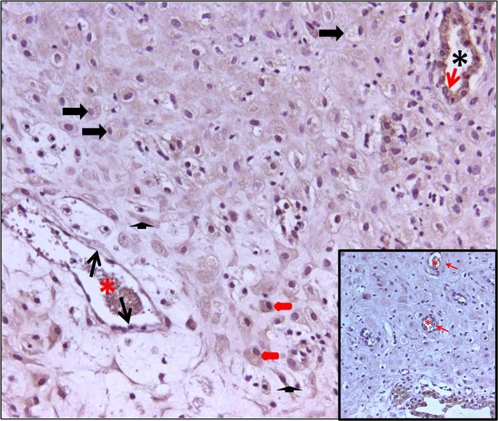 87 Otoimmün hastalık grubu endometriyumunda stromal hücreler, desidual hücreler, ekstravillöz trofoblastalar ve endotel hücrelerinin sitoplazmik olarak immünoreaktif olduğu görüldü.