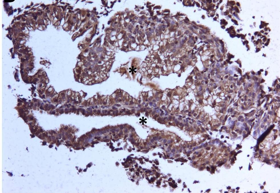 73 Şekil 4.2.2.c.2: LIF MTHFR grubu; Kontrol grubuna göre daha zayıf immünoreaktivite gösteren endometriyum bez epitel hücreleri (endometriyum bezi: yıldızlar) (ABC Yöntemi-Hematoksilen X200).