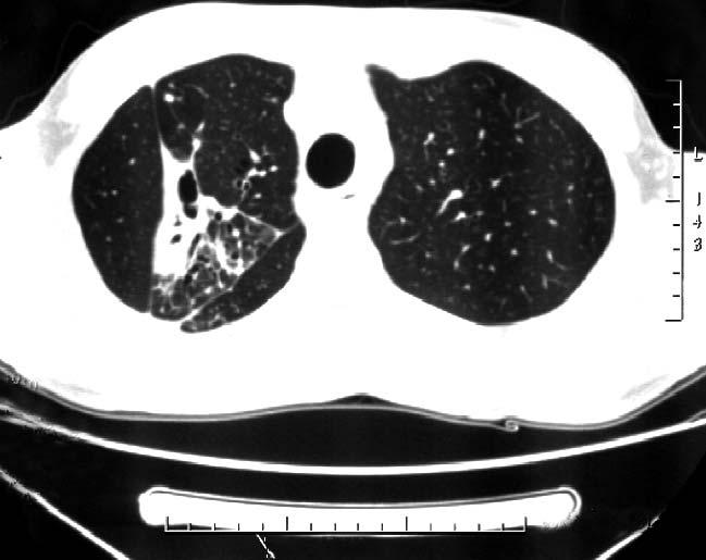 Aktif Tbc tanısı konan hastanın tedavi öncesi YRBT kesitlerinde sağ akciğer üst lobda lobüler konsolidasyon, kalın duvarlı kaviter lezyon, sentrilobüler nodüller görülmektedir. Resim 1B.