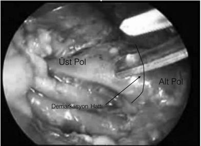 Büyük böbrek ya da özellikle üst pol heminefrektomi yapılacak durumlarda sağ tarafta sağ triangular ligament ve koronar ligamentin anterior kısmının, sol tarafta da frenokolik, splenokolik ve