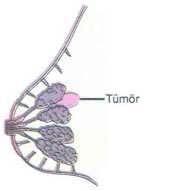 Kanser kendiliğinden oluşabildiği gibi; X ışınları, radyasyon, virüsler ve sigara gibi bazı etkenlerle hücrelerin DNA larının mutasyona uğraması sonucu da meydana gelebilir. 2.