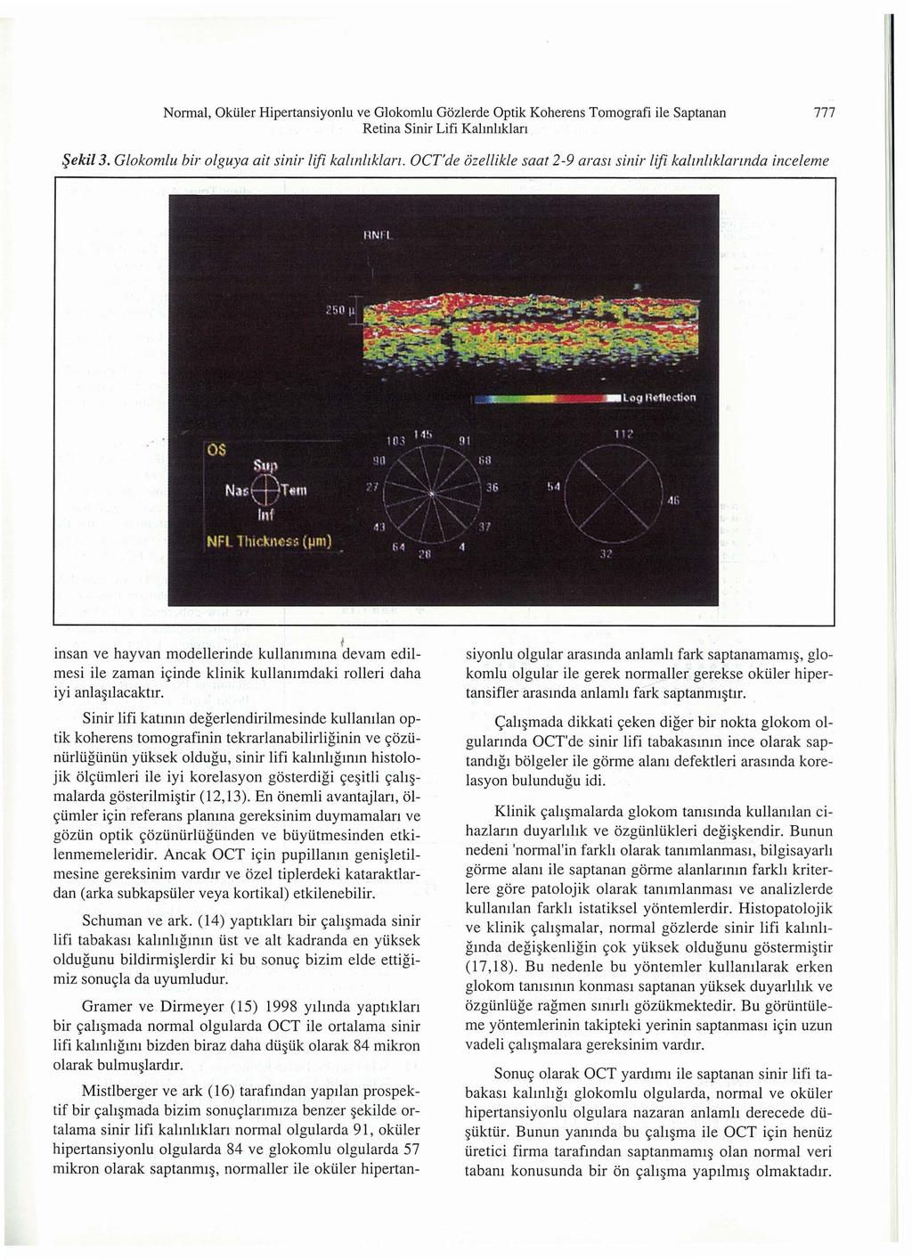 Normal, Okiller Hipertansiyonlu ve Glokomlu Gozlerde Optik Koherens Tomografi ile Saptanan Retina Sinir Lifi Kahnhklan 777!jekil3. Glokomlu bir olguya ait sinir lifi kalmliklan.