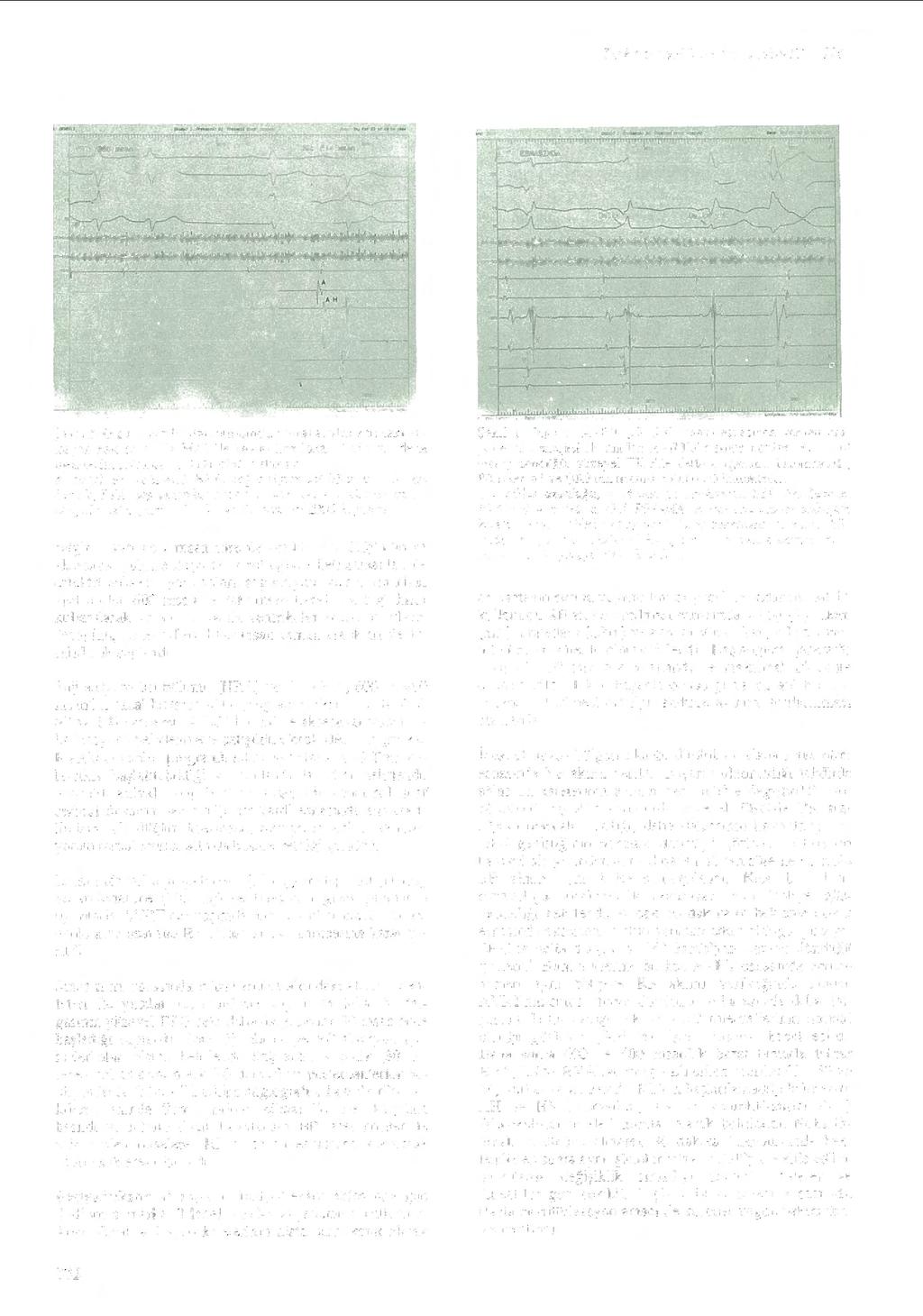 Tiirk Kardiyol Dem Arş 22:330-.1.17. / 994 - --.. t.....,....;..... _,ı, ı -~--- " H ly J ' 1 H V Şekil 3. Olgu 1. S iııüs ri ını; esnasında.