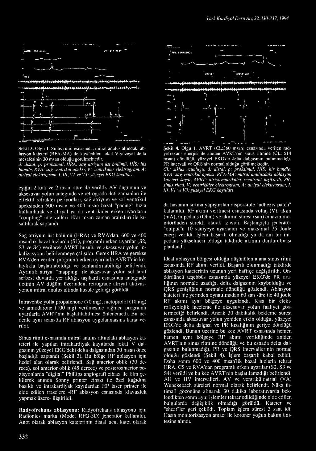 AV düğümün ve aksesuvar yolun antegradc ve retrogradc ileti zaman l a rı ile effektif refrakter periyod ları, sağ atriyum ve sol ventrikül apeksinden 600 ınsan ve 400 ınsan bazal "pacing" hızla