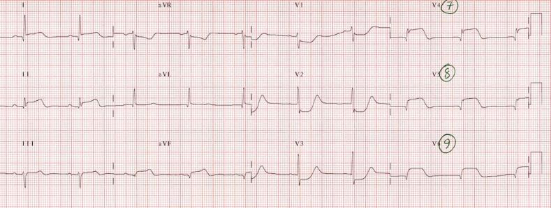 EKG avl ST depresyonu T sivri V1 de yeni yüksek T dalgası avr de ST elevasyonu = kötü prognoz V2-V3, ±V4