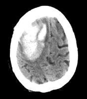 Kraniyal BT: Normal Kraniyal MR: Beyin sapında ödem ve hiperintens lezyonlar TANI: Hipertansif ensefalopati A. Tedavisiz izlem B. Parenteral nitroprussid ile KB nın kademeli olarak düşürülmesi C.