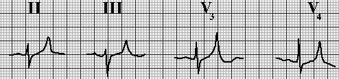Hiperkaleminin EKG bulguları Hiperkaleminin EKG bulguları ***K değeri 5,5-6,5